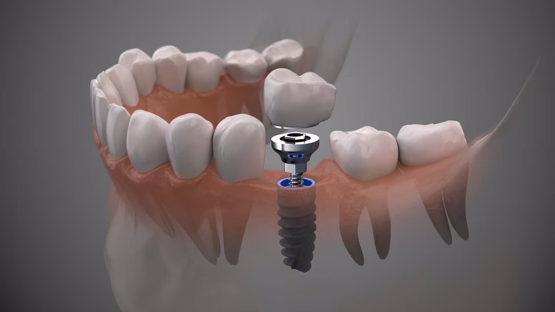 Single Tooth Implants